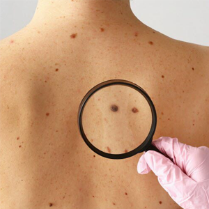 Dépistage Cancers Cutanés Carcinomes et Mélanomes à Vence